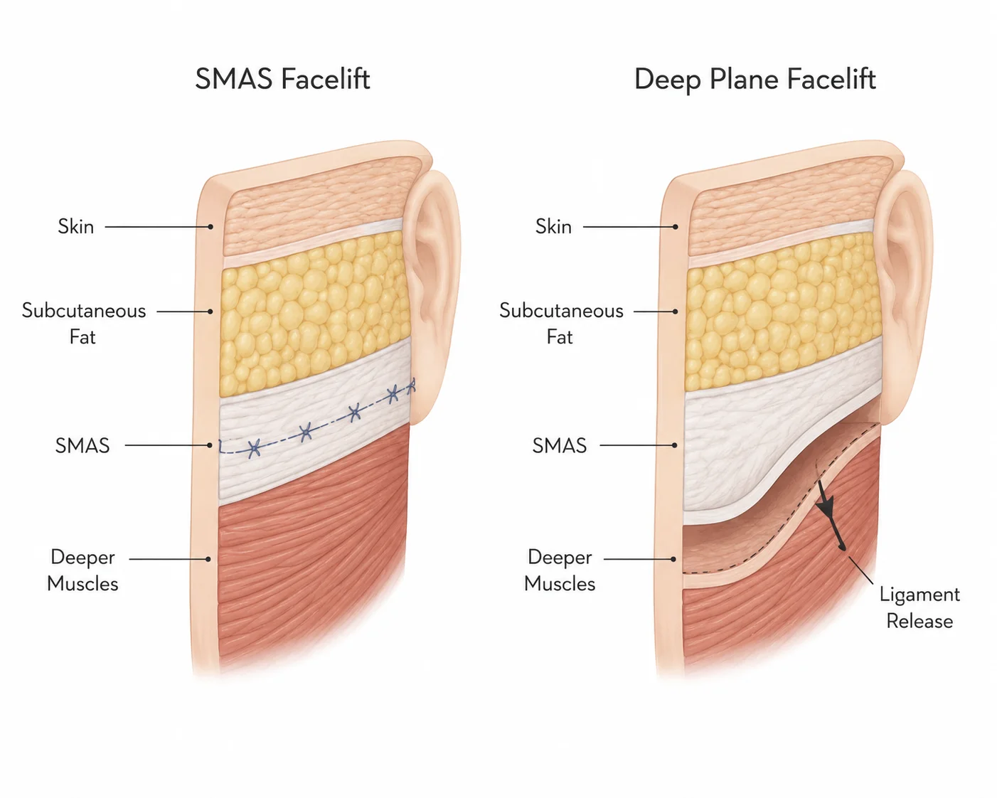 SMAS vs Deep Plane Facelift Cross-section